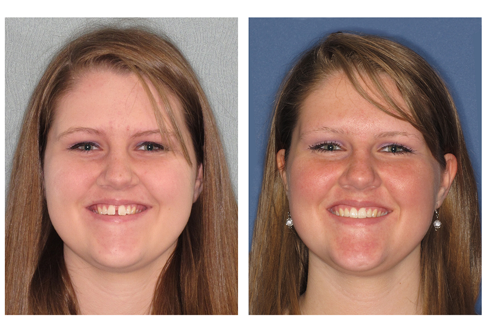Invisalign® Before and After Photos Calverton Dental Care
