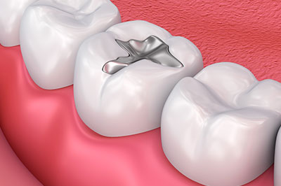 Calverton Dental Care | Cosmetic Dentistry, Dentures and Dental Fillings
